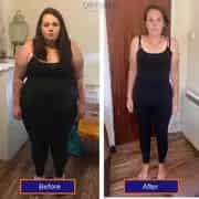 Before and after Gastric SLeeve in Antalya