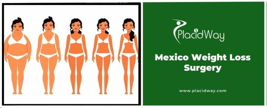 Mexico Weight Loss Surgery