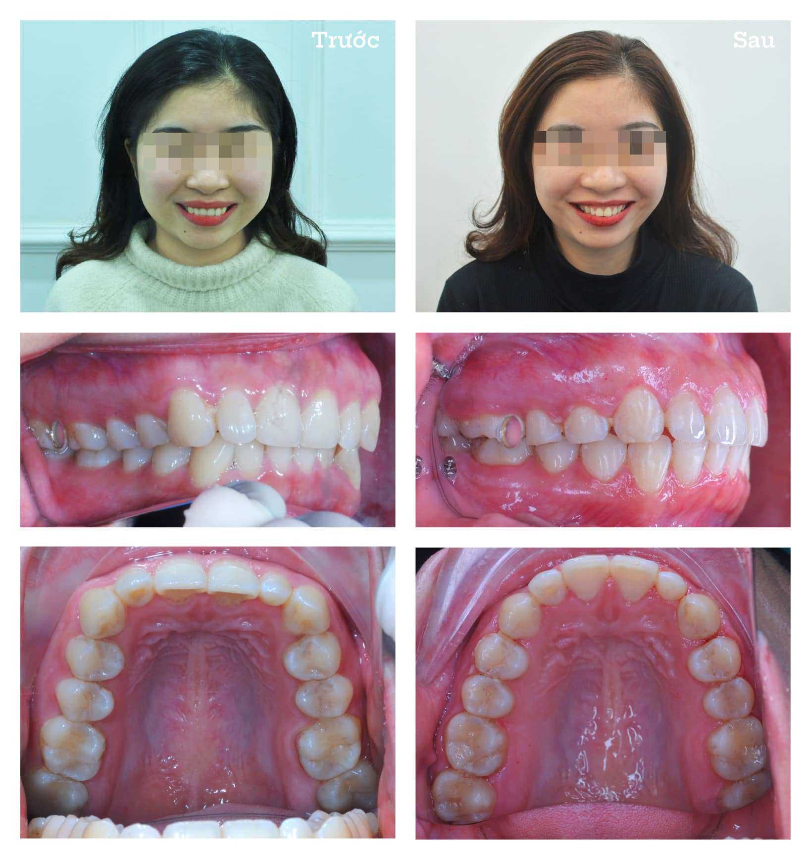 Before After - Dental Braces in Hanoi, Vietnam