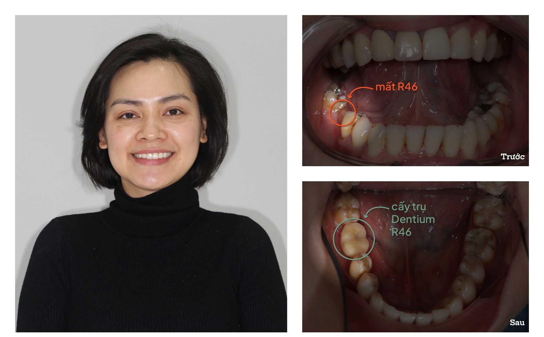 Before After - Dental Implant in Hanoi, Vietnam
