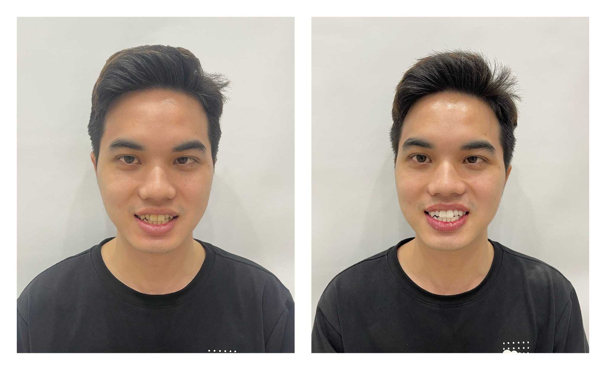 Before After - Laser Teeth Whitening in Hanoi, Vietnam