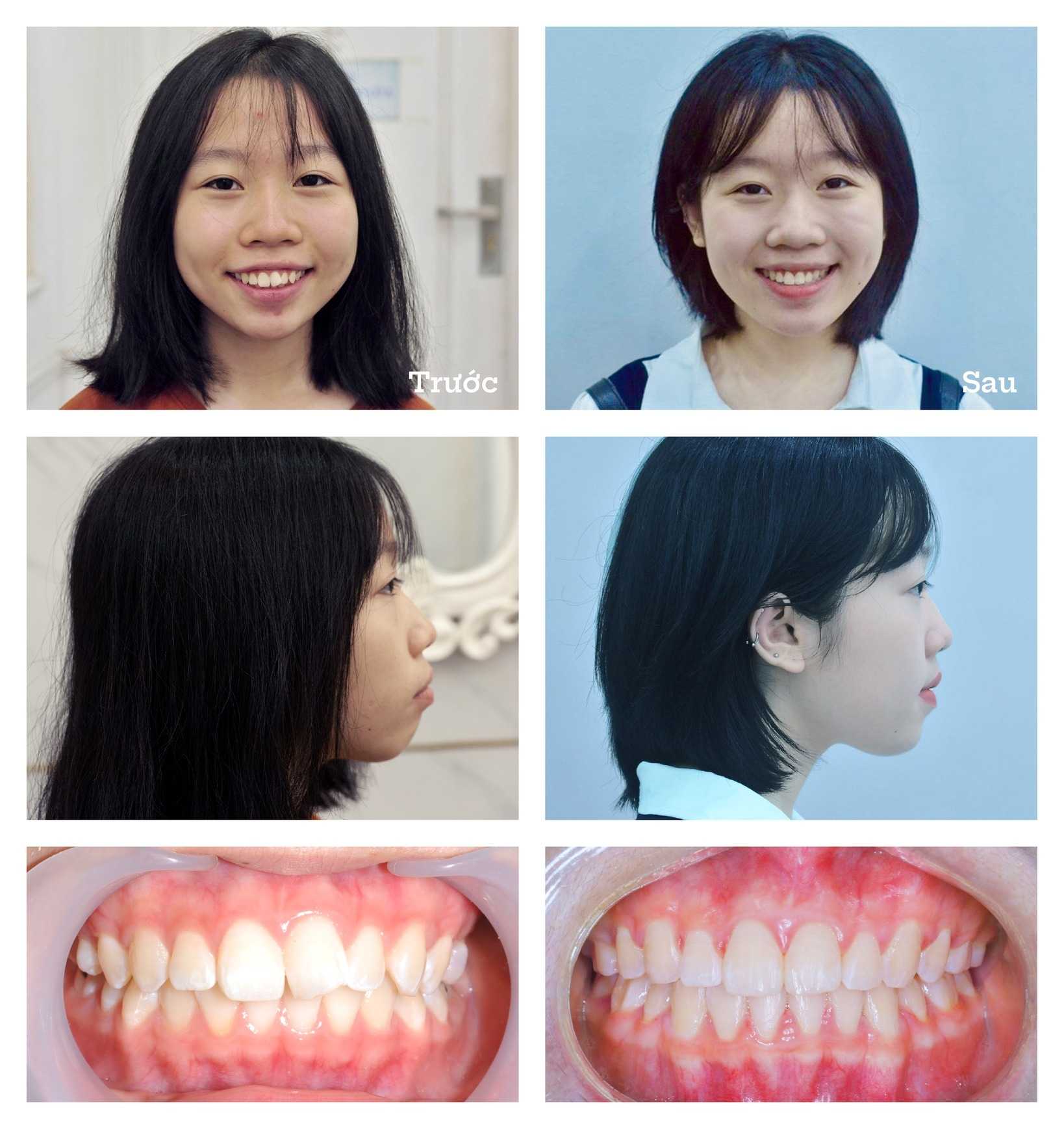 Before After - Dental Braces in Hanoi, Vietnam