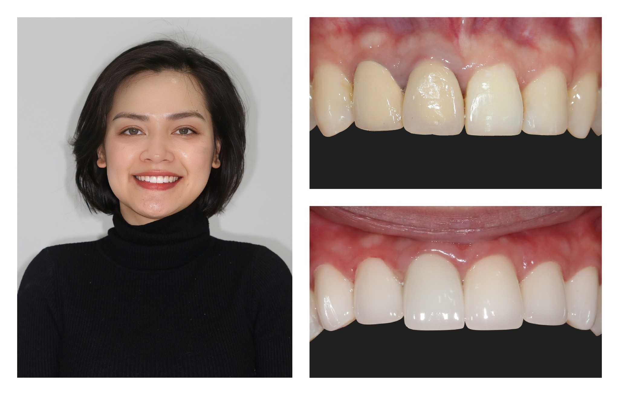 Before After - Porcelain Teeth in Hanoi, Vietnam