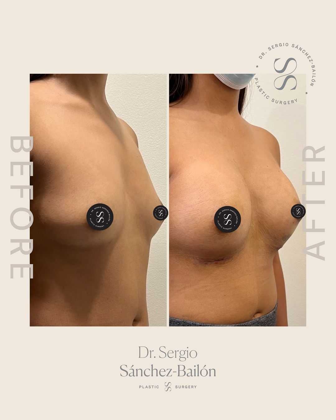 Before After Breast Augmentation in Tijuana Mexico