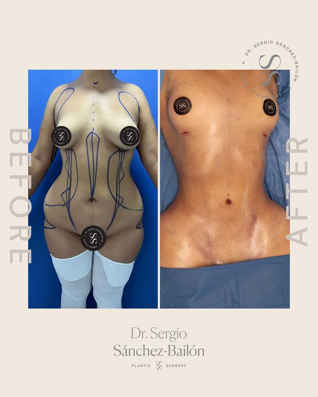 Before After Liposuction in Tijuana Mexico