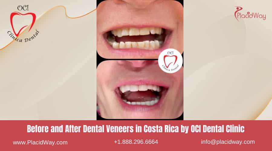 Dental Veneers In Costa Rica By Oci Dental Clinic   Before And After