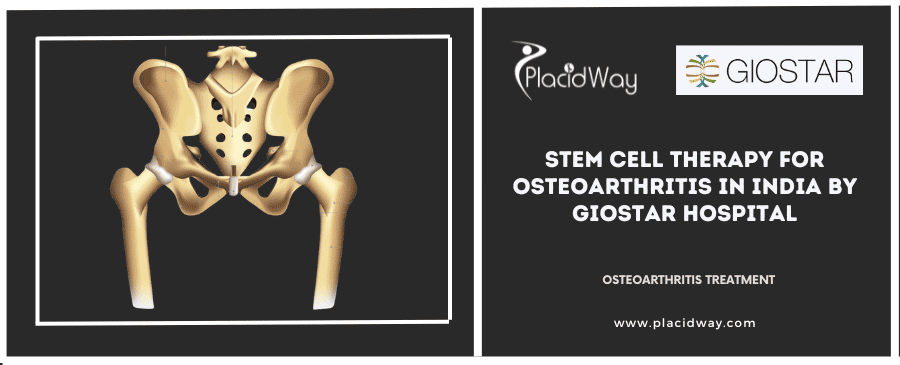Stem Cell Therapy for Osteoarthritis in India By GIOSTAR Hospital
