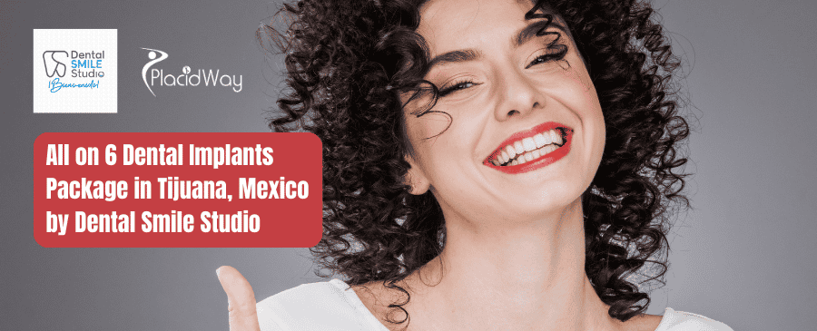 All on 6 Dental Implants Package in Tijuana, Mexico by Dental Smile Studio
