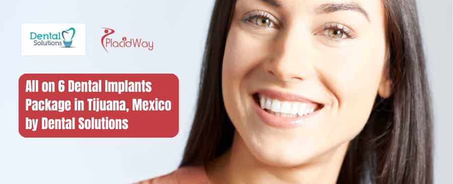 Paquete de implantes dentales All on 6 en Tijuana, México de Dental Solutions
