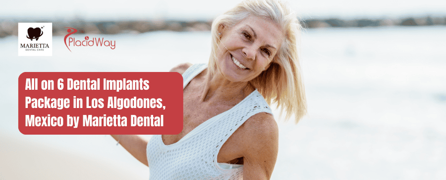 Marietta All on 6 Dental Implants Package in Los Algodones, Mexico