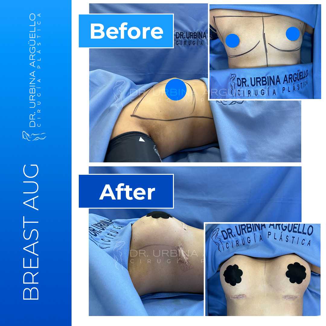 Before and After Breast Implant in Matamoros, Mexico