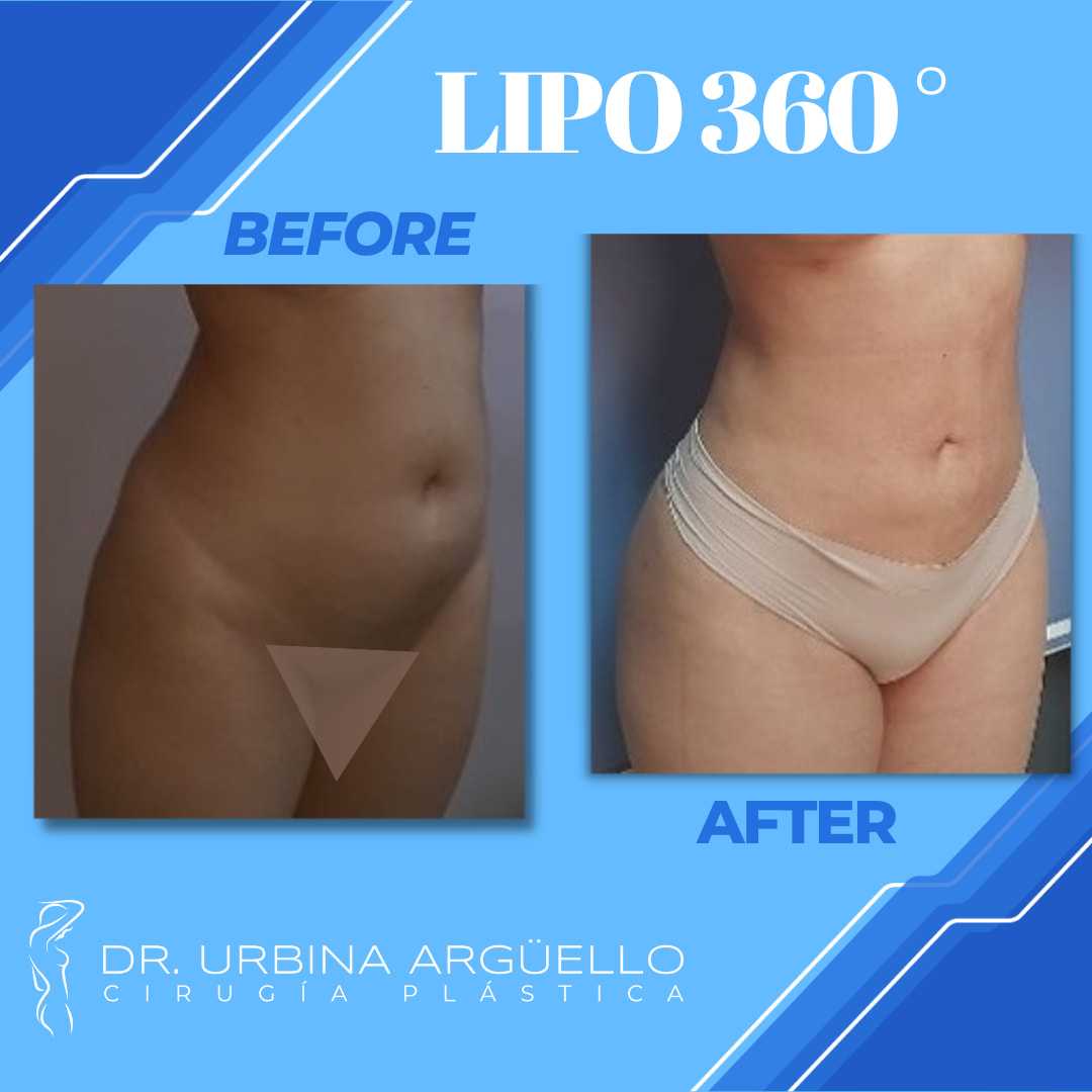Before and After Liposuction in Matamoros, Mexico