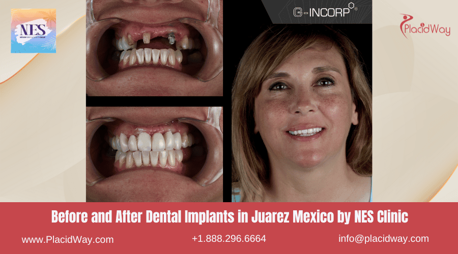 Before and After Dental Implants in Juarez Mexico by NES Clinic