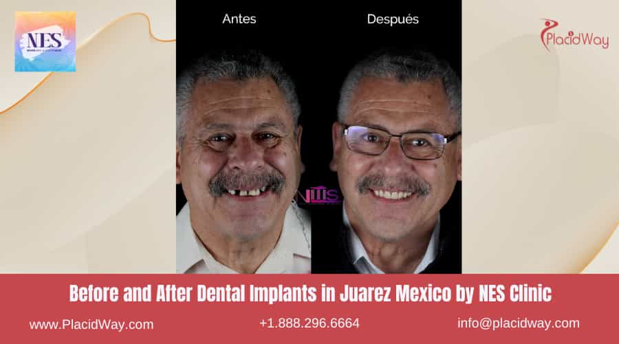 Before and After Teeth Implants in Juarez Mexico by NES Clinic