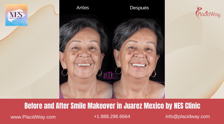 Before and After Smile Makeover in Juarez Mexico by NES Clinic