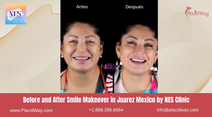 Before and After Image for Smile Makeover in Juarez Mexico by NES Clinic