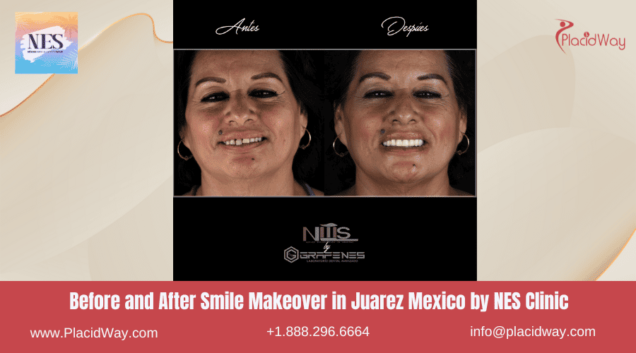 Smile Makeover in Juarez Mexico by NES Clinic Before and After Picture
