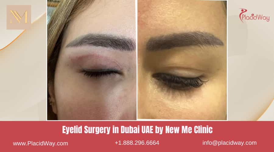Eyelid Surgery in Dubai UAE by New Me Clinic - Before After