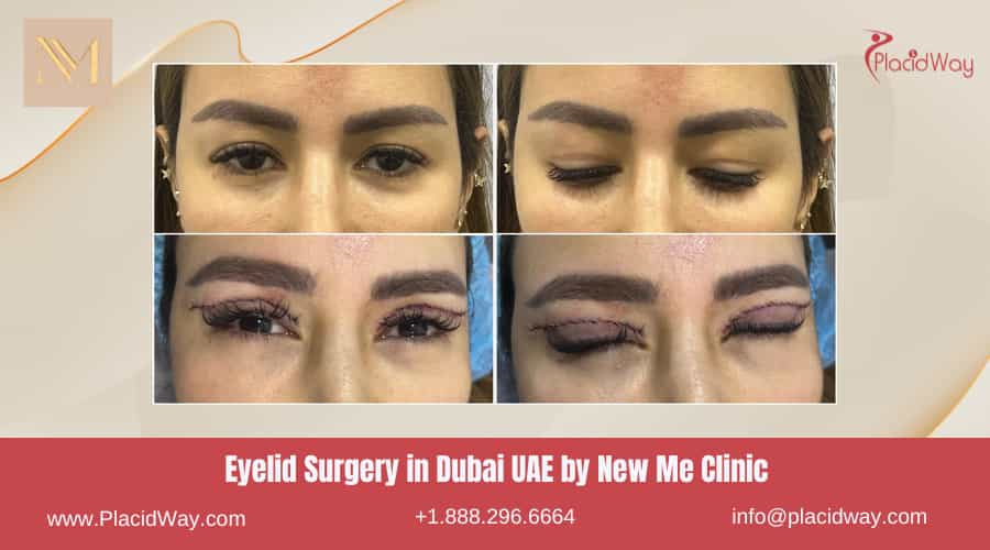 Eyelid Surgery in Dubai UAE by New Me Clinic - Before and After Images