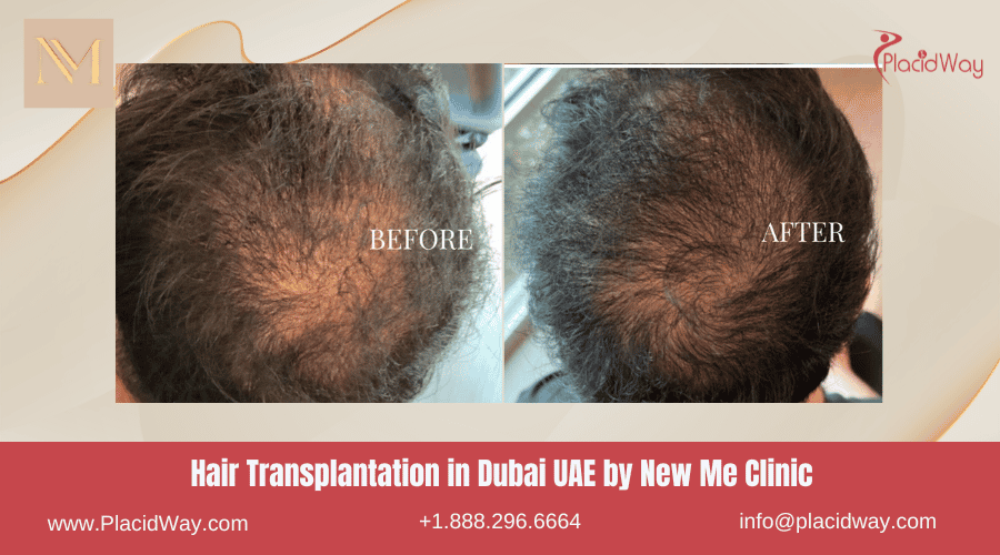 Hair Transplantation in Dubai UAE by New Me Clinic - Before and After