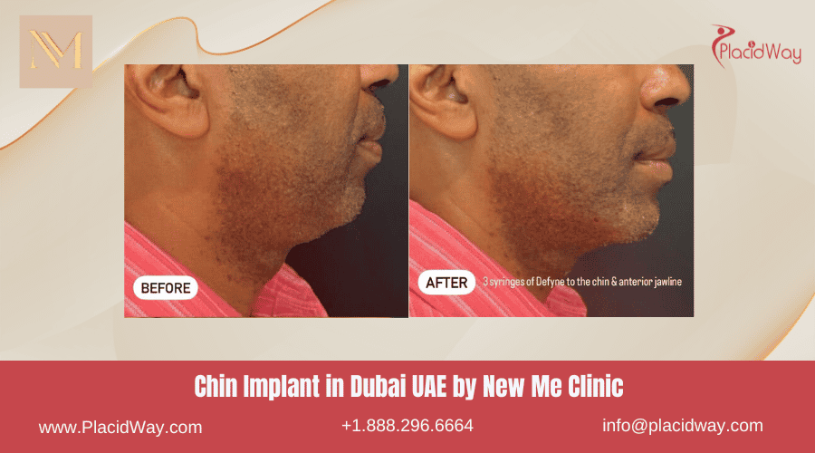 Chin Implant in Dubai UAE by New Me Clinic - Before and After