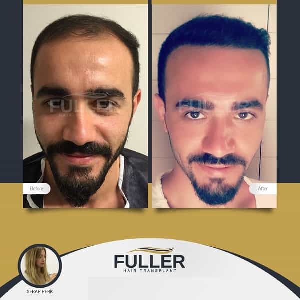 Fuller Hair Transplant Clinic in Istanbul Turkey Before After Image