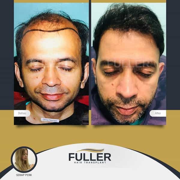 Before After Image Fuller Hair Transplant Clinic in Istanbul Turkey
