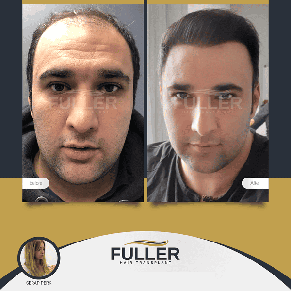 Fuller Hair Transplant Clinic in Istanbul Turkey Before After Transformation