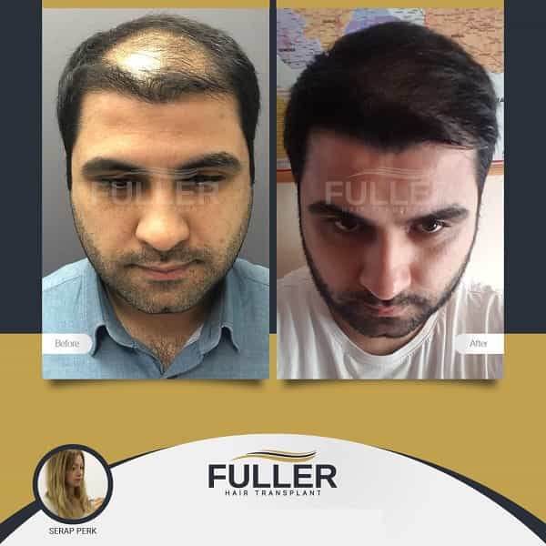 Before After Transformation at Fuller Hair Transplant Clinic in Istanbul Turkey
