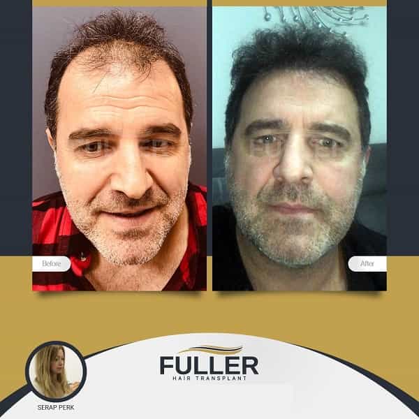 Before After Image for Hair Restoration in Istanbul Turkey