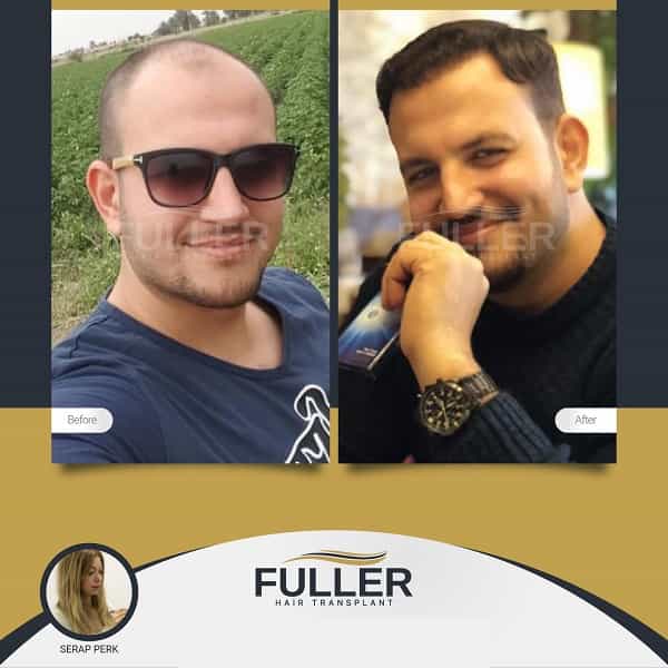 Before After Image for Hair Restoration in Istanbul Turkey at Fuller Hair Clinic