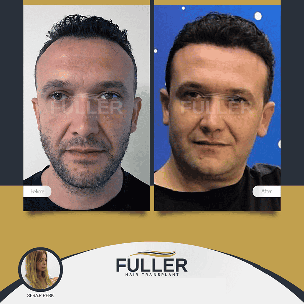 Before After Image for Hair Restoration in Istanbul Turkey by Serap PERK