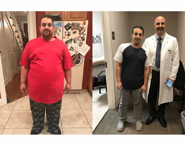 Before and After Images for Bariatric Surgery in Valhalla, New York, USA