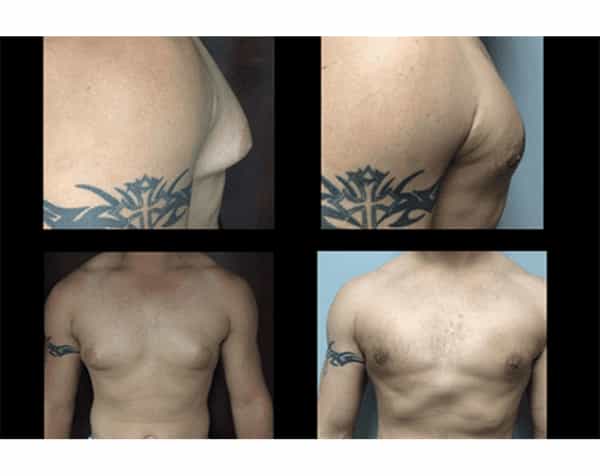 Before and After Images for Smartlipo in Valhalla, New York, USA