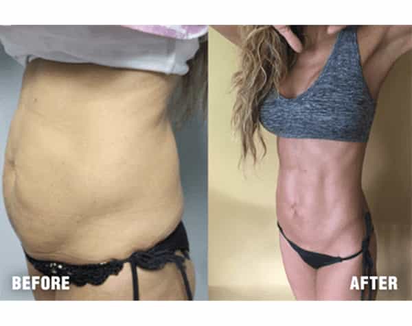 Before and After Smartlipo in Valhalla, New York, USA