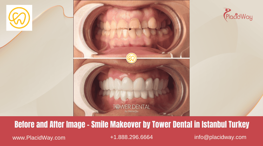 Before and After Image - Smile Makeover by Tower Dental in Istanbul Turkey