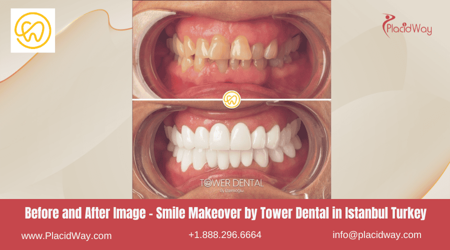 Before and After Smile Makeover by Tower Dental in Istanbul Turkey