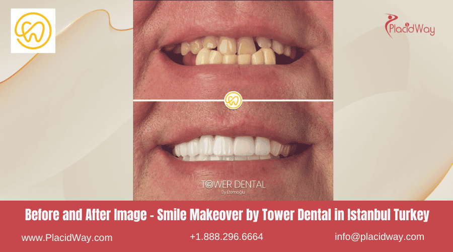 Before and After Picture Smile Makeover by Tower Dental in Istanbul Turkey