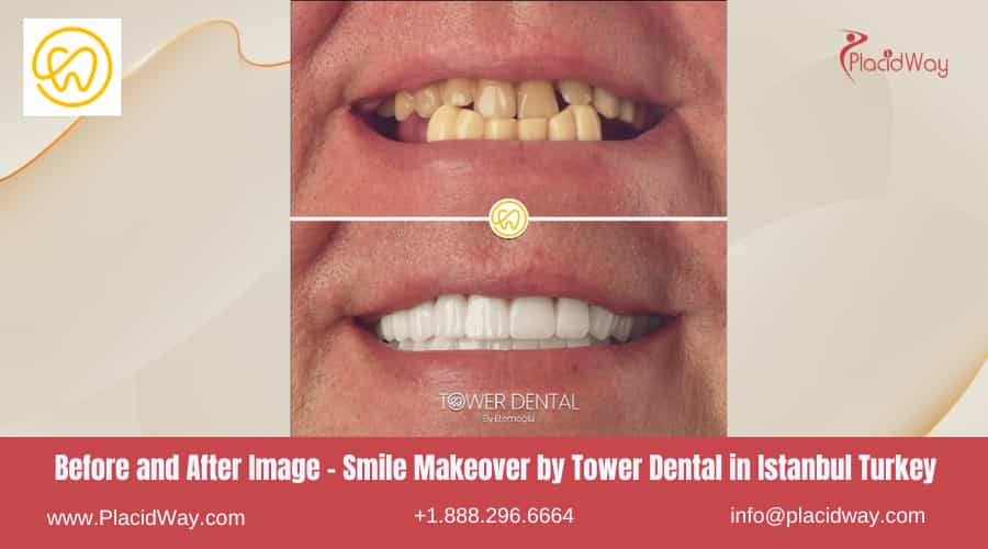 Before and After Picture Smile Makeover by Tower Dental in Istanbul Turkey