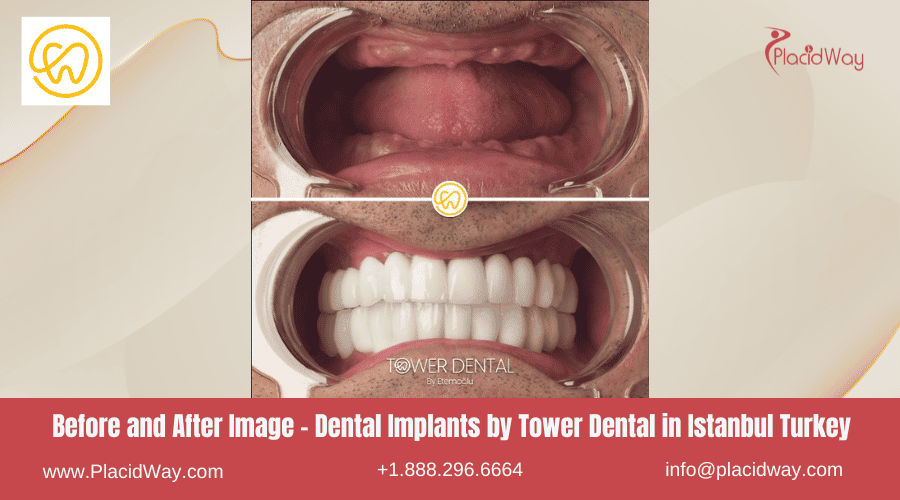 Before and After Image - Dental Implants by Tower Dental in Istanbul Turkey