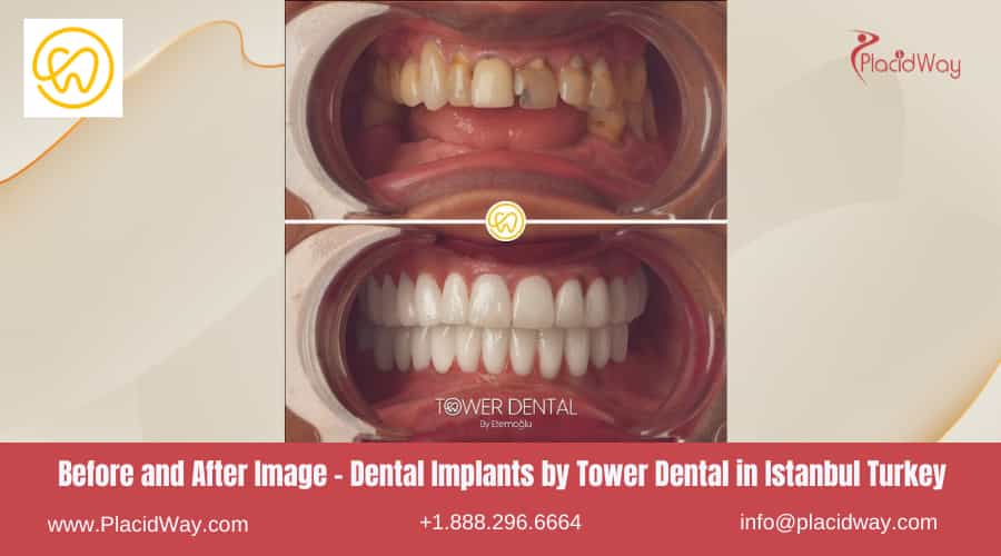 Before and After Dental Implants by Tower Dental in Istanbul Turkey