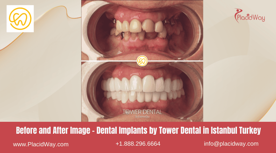 Before and After Image Dental Implants in Istanbul Turkey by Tower Dental 
