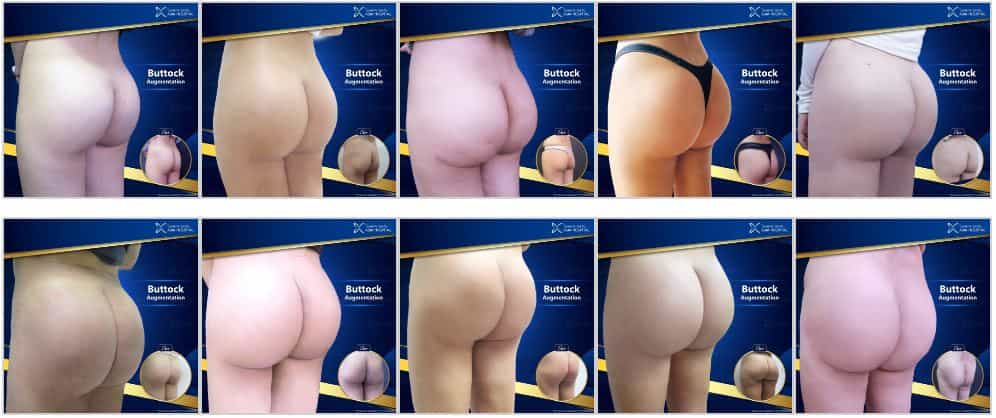 Before and After Asia Cosmetic Hospital - Buttock Augmentation