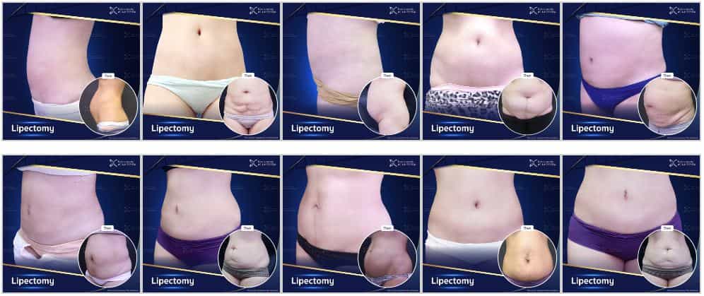 Before and After Asia Cosmetic Hospital - Lipectomy