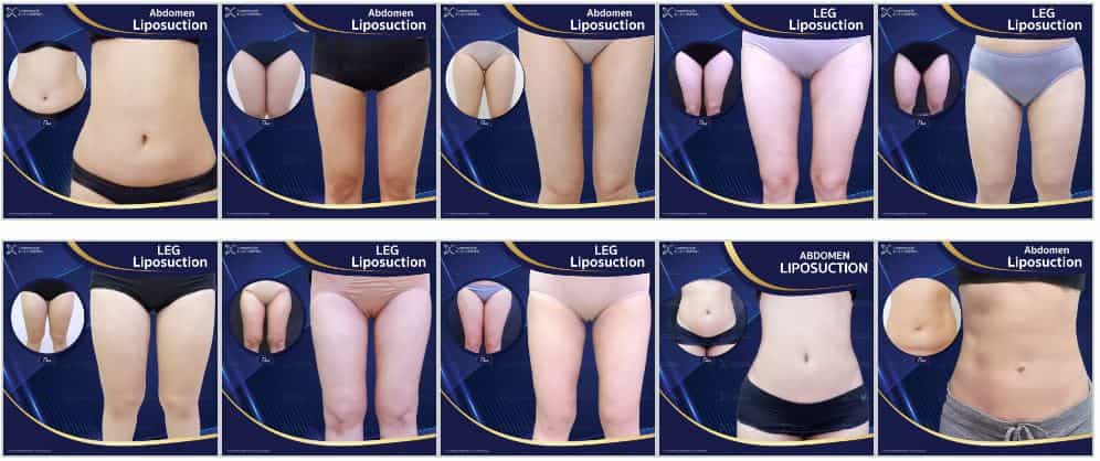 Before and After Asia Cosmetic Hospital - Liposuction