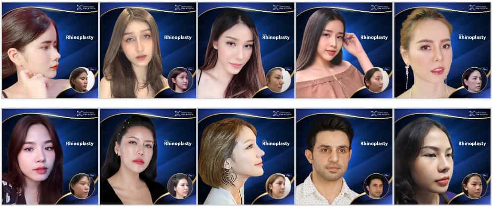 Before and After Asia Cosmetic Hospital - Rhinoplasty