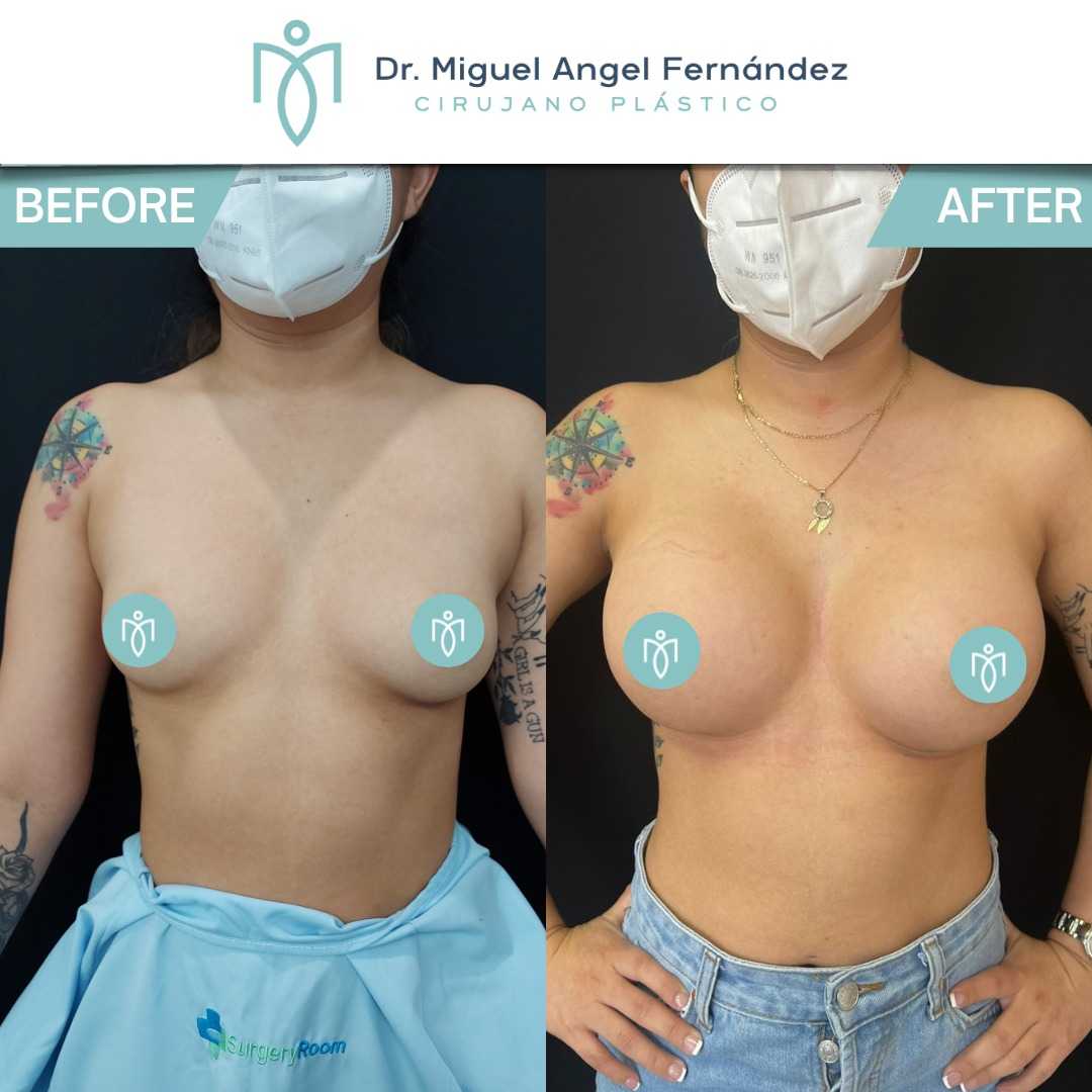 Before After - Dr. Miguel Angel Fernandez - Breast Augmentation in Mexicali Mexico