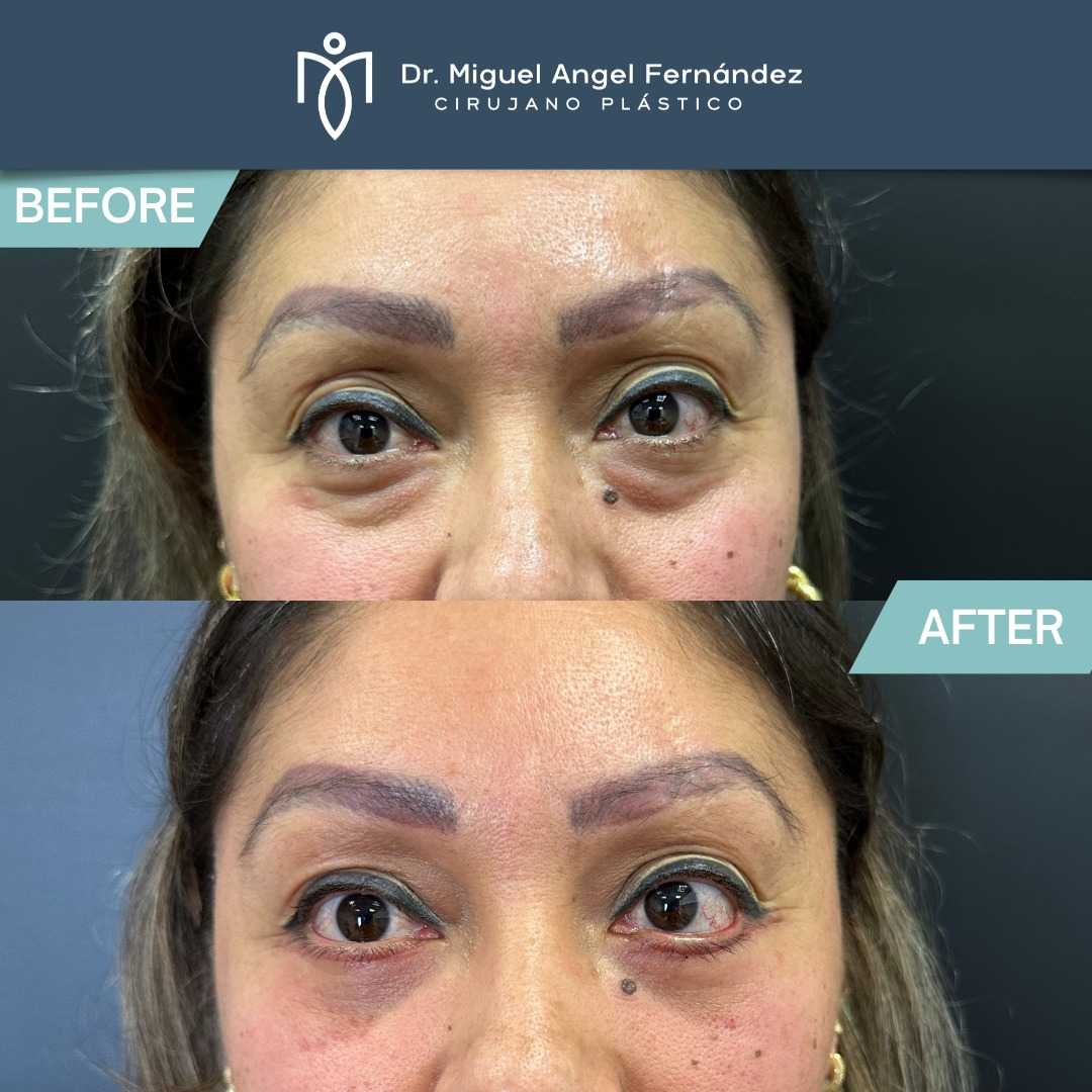 Before After - Dr. Miguel Angel Fernandez - Eyelid Surgery in Mexicali Mexico