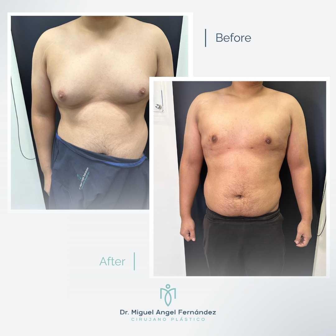 Before After - Dr. Miguel Angel Fernandez - Gynecomastia in Mexicali Mexico