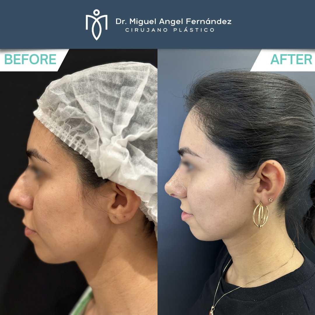 Before After - Dr. Miguel Angel Fernandez - Rhinoplasty in Mexicali Mexico